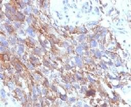 IHC testing of FFPE human lung carcinoma with CD56 antibody.