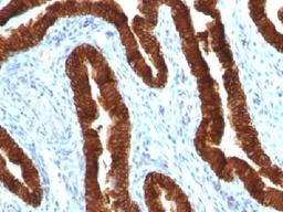 Immunohistochemical staining of human Ovarian Carcinoma tissue using KRT19 antibody