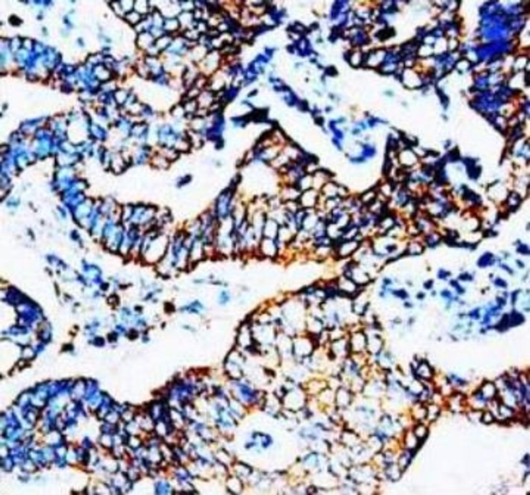 IHC-P of human rectal carcinoma tissue (CCR5 antibody at 1:300)