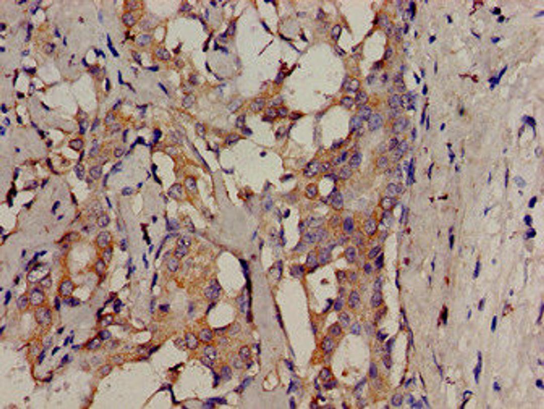 Immunohistochemistry analysis of human breast cancer using CSB-PA862011LA01HU at dilution of 1:100