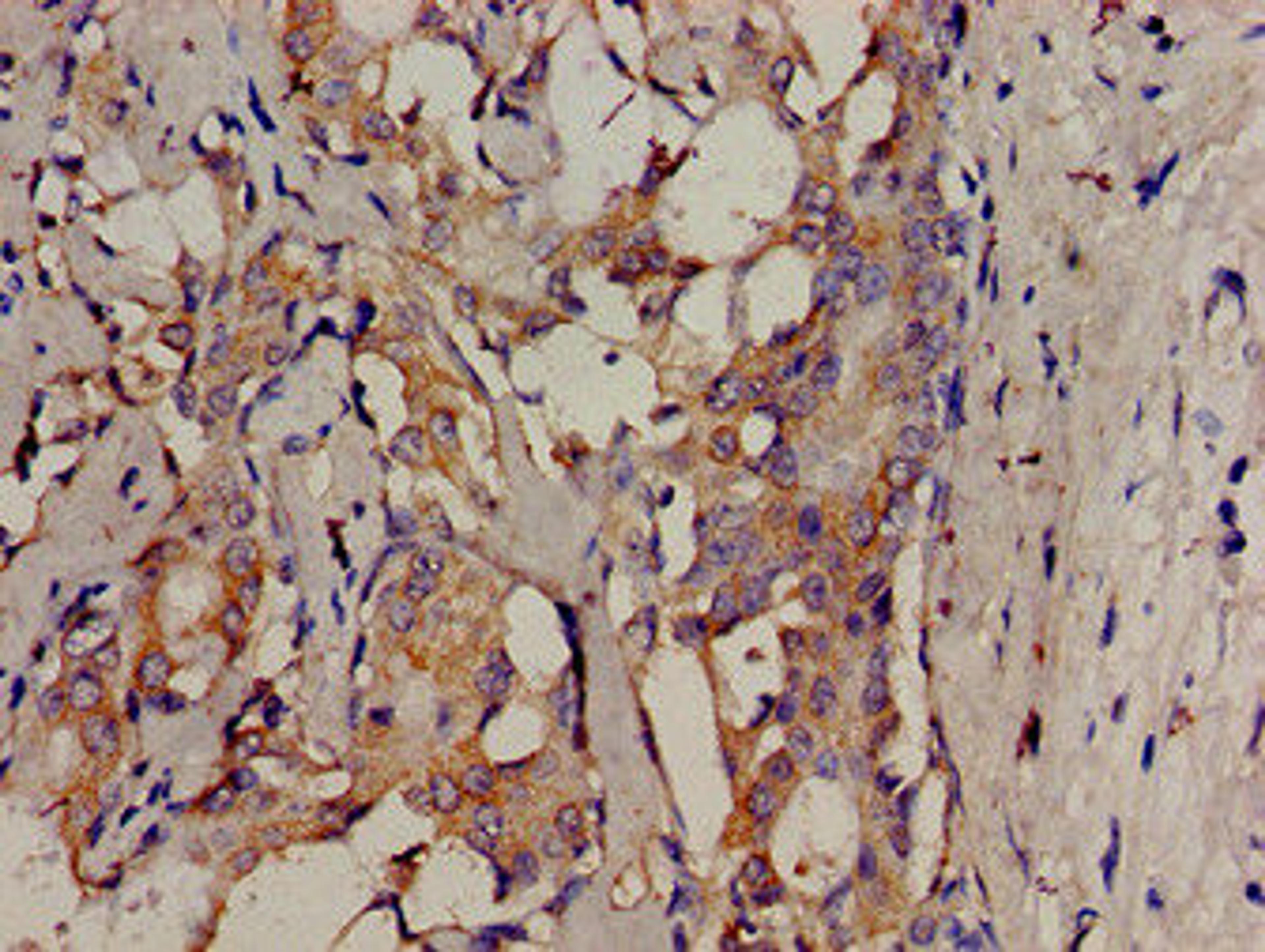 Immunohistochemistry analysis of human breast cancer using CSB-PA862011LA01HU at dilution of 1:100