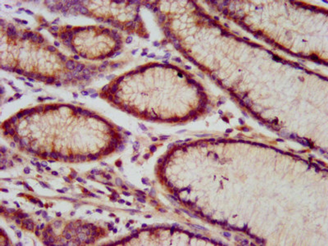 IHC image of CSB-PA717453LA01HU diluted at 1:800 and staining in paraffin-embedded human gastric cancer performed on a Leica BondTM system. After dewaxing and hydration, antigen retrieval was mediated by high pressure in a citrate buffer (pH 6.0). Section was blocked with 10% normal goat serum 30min at RT. Then primary antibody (1% BSA) was incubated at 4&deg;C overnight. The primary is detected by a biotinylated secondary antibody and visualized using an HRP conjugated SP system.