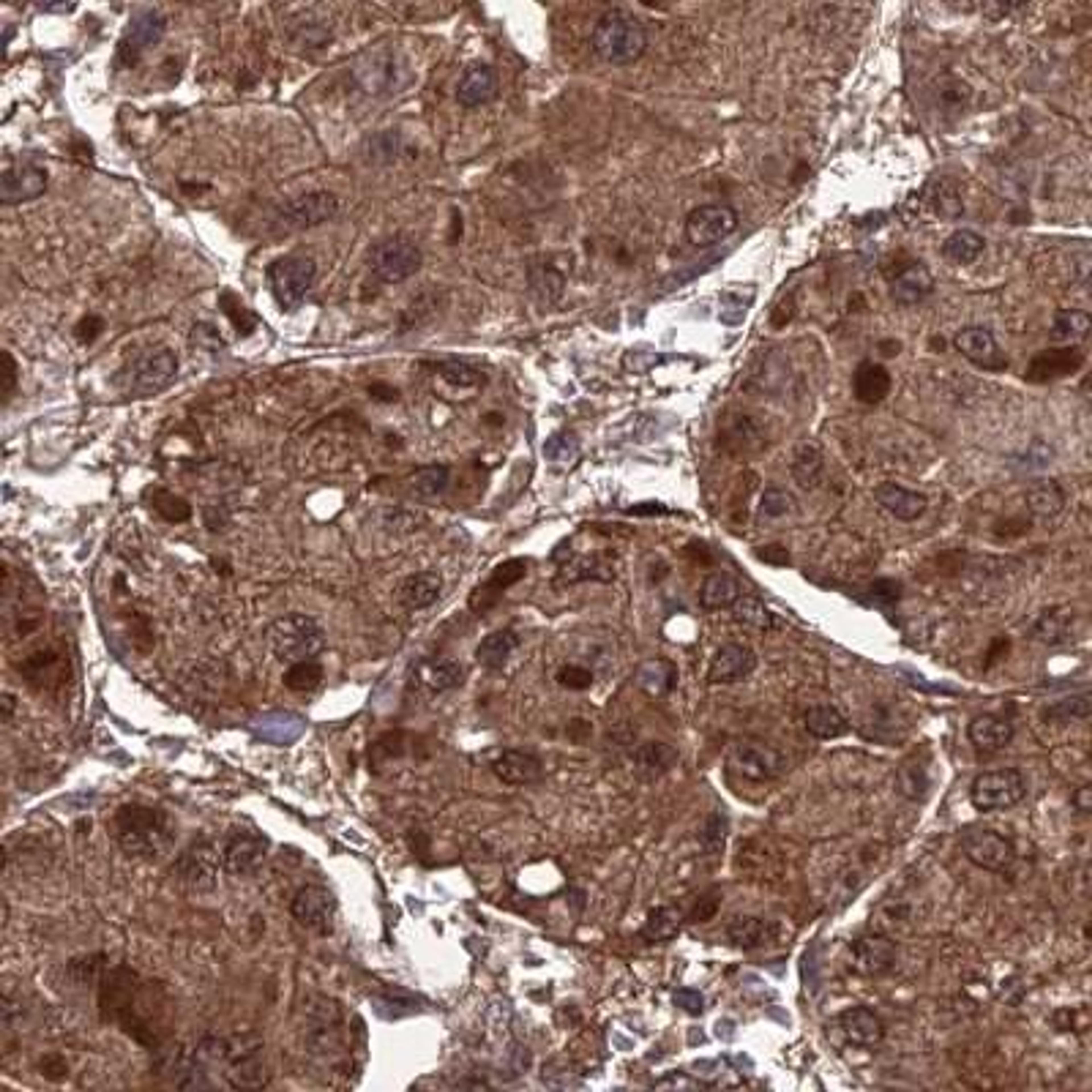 Immunohistochemistry: RALGAPA2 Antibody [NBP2-34082] - liver cancer