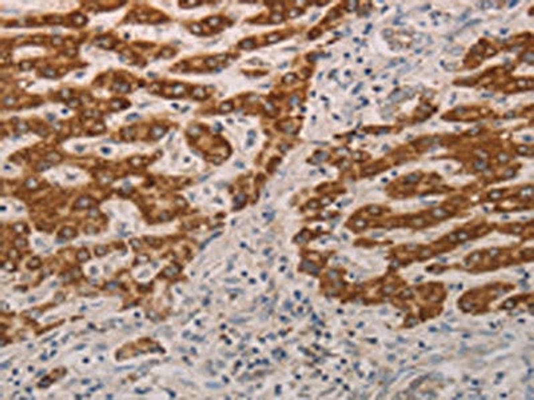 The image on the left is immunohistochemistry of paraffin-embedded Human liver cancer tissue using CSB-PA480938(AIFM1 Antibody) at dilution 1/15, on the right is treated with fusion protein. (Original magnification: ×200)