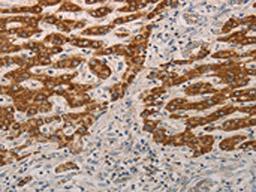 The image on the left is immunohistochemistry of paraffin-embedded Human liver cancer tissue using CSB-PA480938(AIFM1 Antibody) at dilution 1/15, on the right is treated with fusion protein. (Original magnification: ×200)