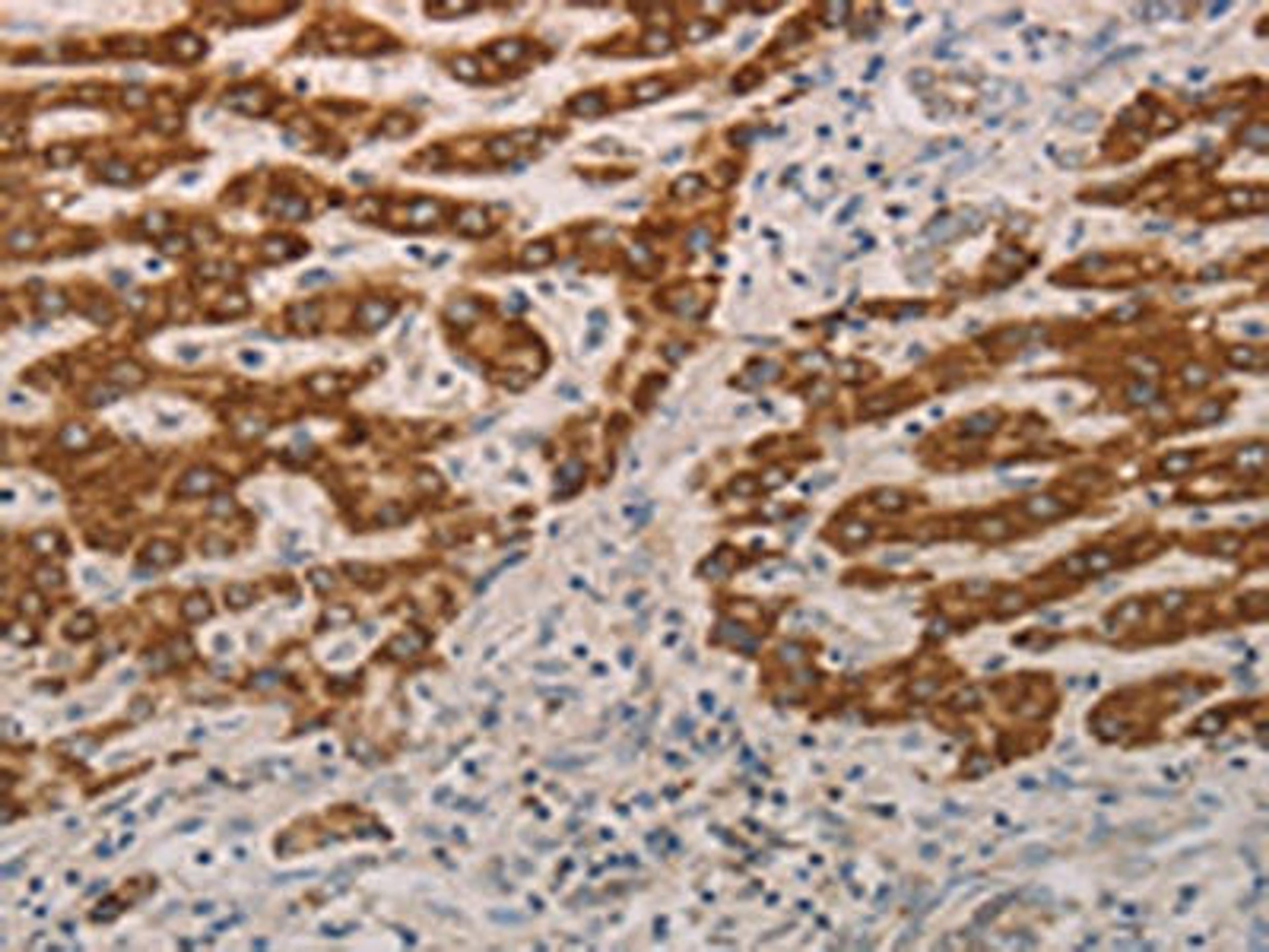 The image on the left is immunohistochemistry of paraffin-embedded Human liver cancer tissue using CSB-PA480938(AIFM1 Antibody) at dilution 1/15, on the right is treated with fusion protein. (Original magnification: ×200)