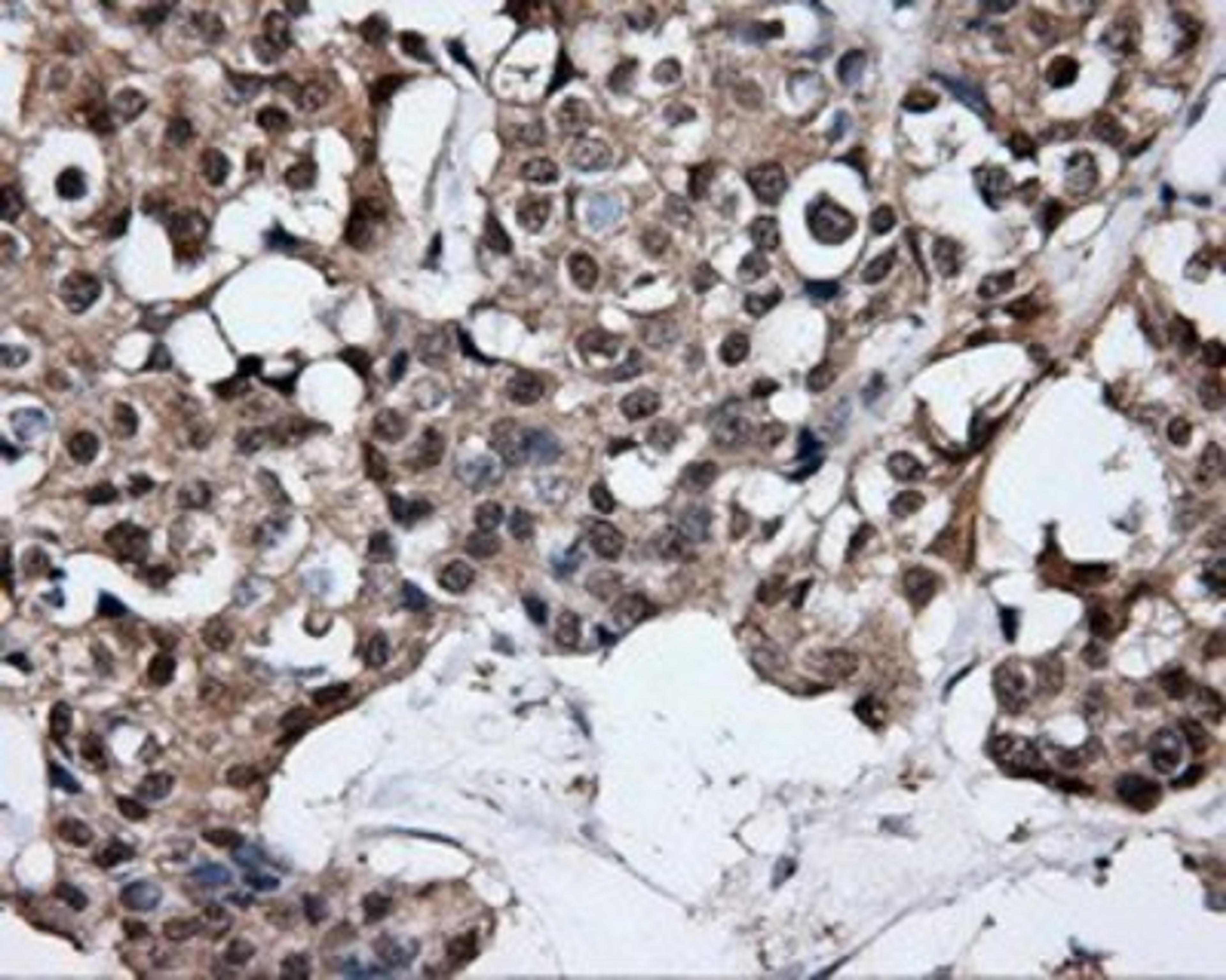 Immunohistochemistry-Paraffin: HuR/ELAVL1 Antibody (14F4) [NBP2-02287] - Staining of paraffin-embedded Adenocarcinoma of breast tissue using anti-HuR/ELAVL1 mouse monoclonal antibody.