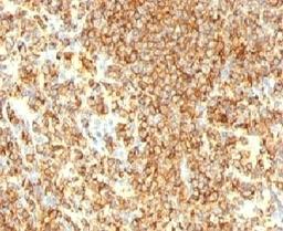 IHC testing of CD20 antibody and human lymphoma tissue