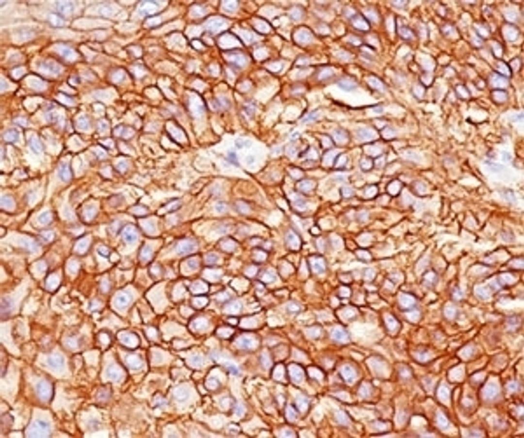 IHC testing of squamous cell carcinoma stained with EGFR antibody (GFR450).