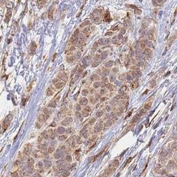 Immunohistochemistry: CEP170 Antibody [NBP2-33449] - breast cancer