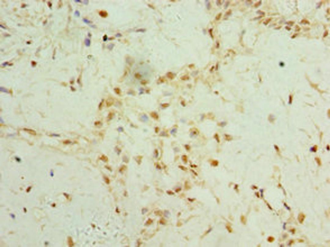 Immunohistochemistry of paraffin-embedded human breast cancer using CSB-PA764560ESR1HU at dilution of 1:100