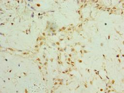 Immunohistochemistry of paraffin-embedded human breast cancer using CSB-PA764560ESR1HU at dilution of 1:100