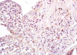 Immunohistochemical analysis of formalin-fixed paraffin embedded human lung carcinoma tissue using CD80 antibody (dilution at 1:200)