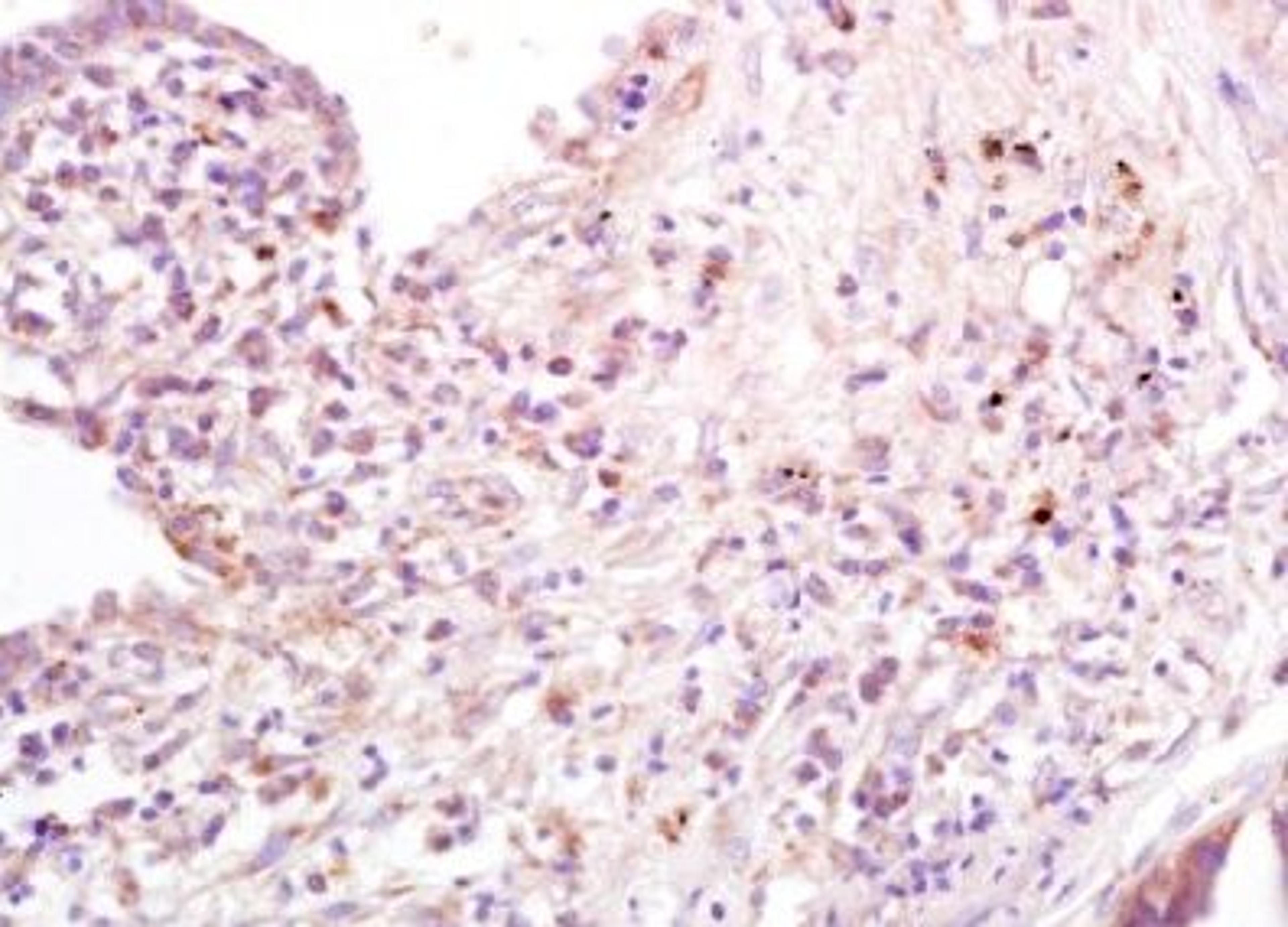 Immunohistochemical analysis of formalin-fixed paraffin embedded human lung carcinoma tissue using CD80 antibody (dilution at 1:200)