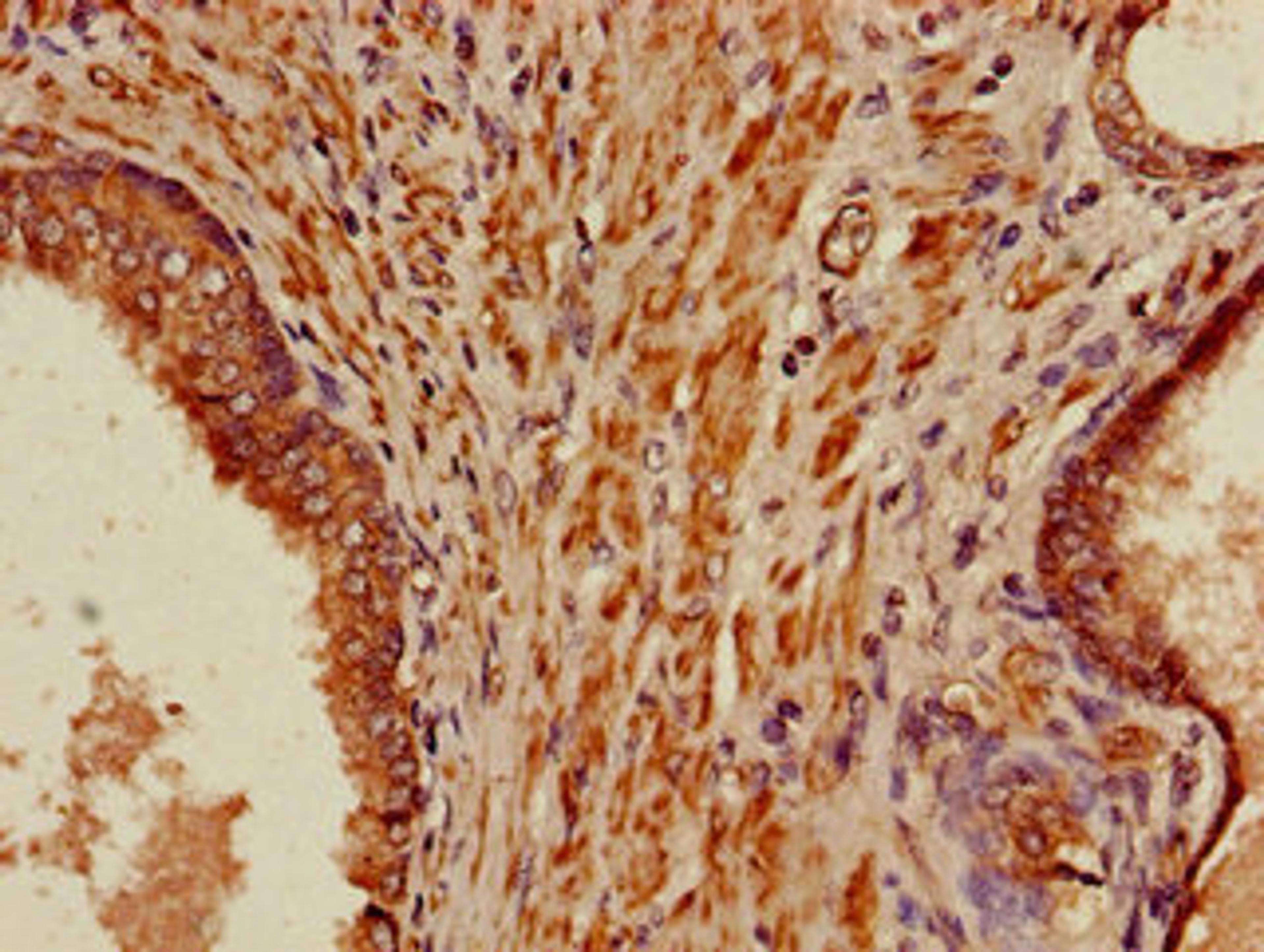 Immunohistochemistry of paraffin-embedded human prostate cancer using CSB-PA878855LA01HU at dilution of 1:100