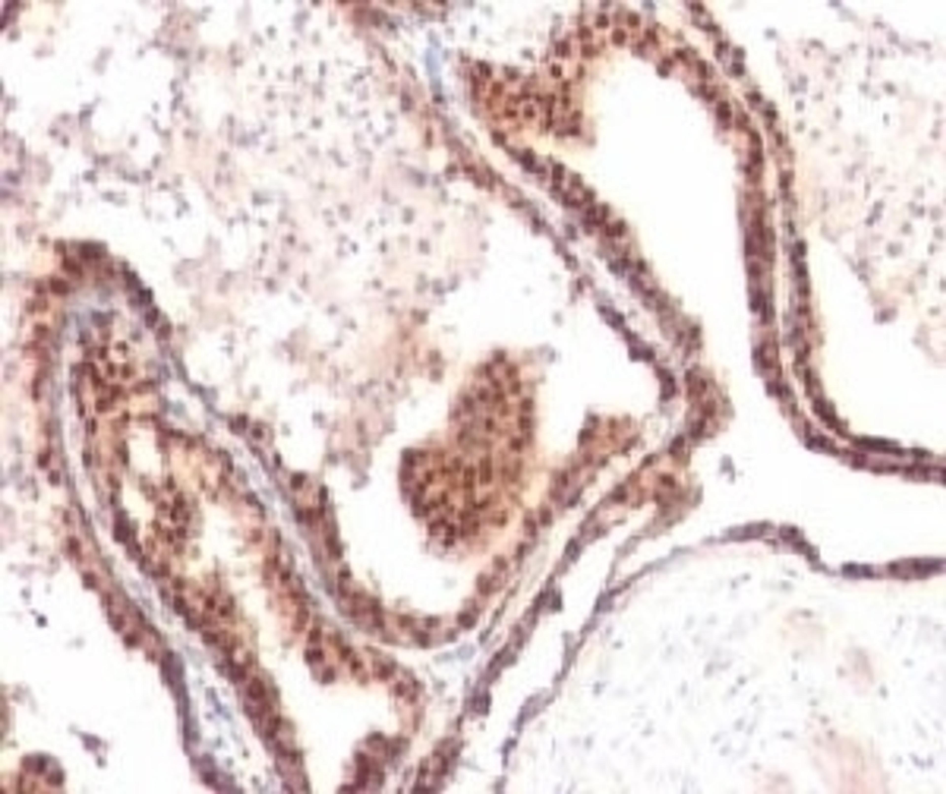 IHC testing of FFPE human prostate cancer and p27Kip1 antibody (clone KIP27-1).