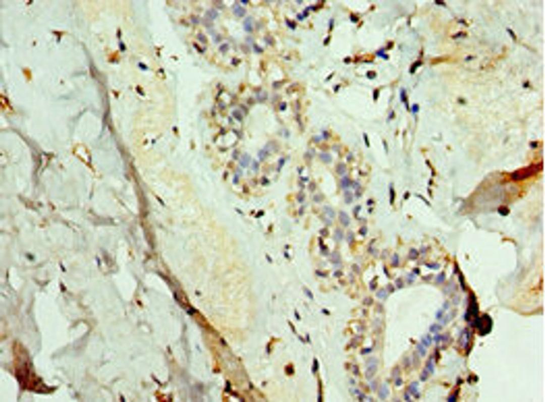 Immunohistochemistry of paraffin-embedded human breast cancer using CSB-PA009080ESR1HU at dilution of 1:100
