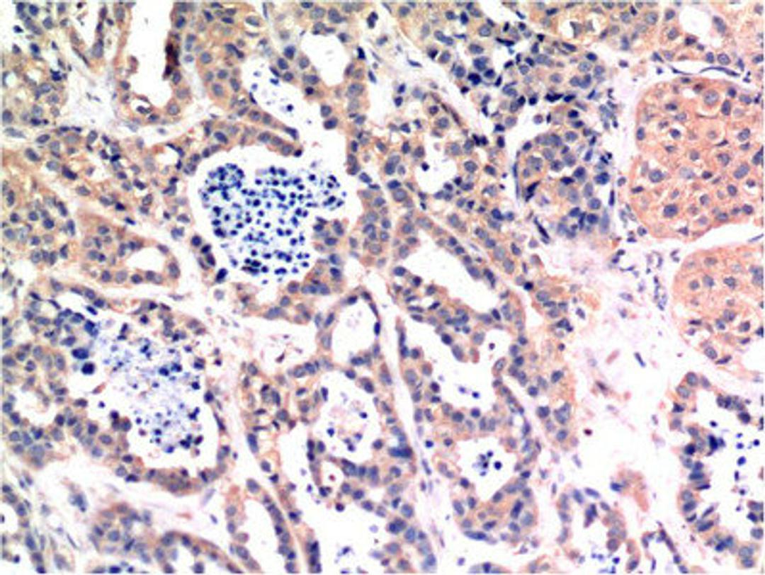 Immunohistochemical analysis of paraffin-embedded Human Breast Carcinoma Tissue using Bax Mouse mAb diluted at 1:200.