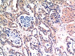 Immunohistochemical analysis of paraffin-embedded Human Breast Carcinoma Tissue using Bax Mouse mAb diluted at 1:200.