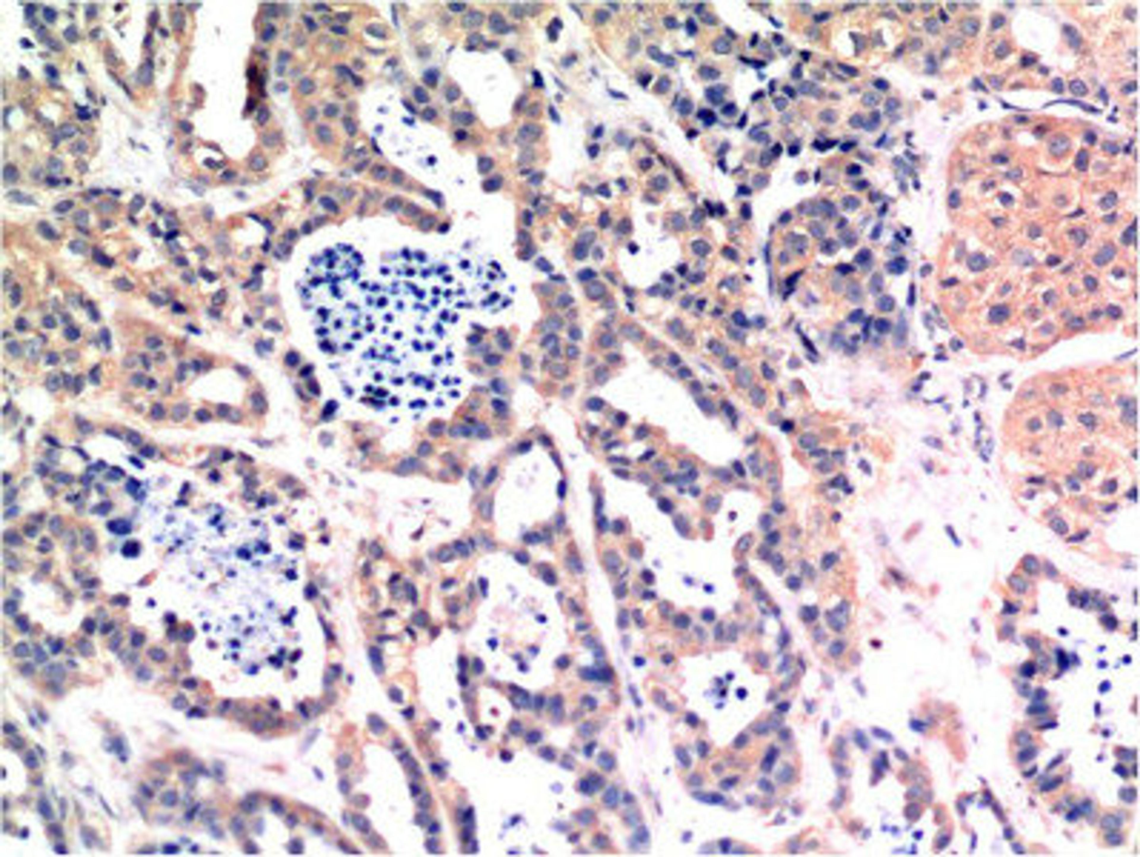 Immunohistochemical analysis of paraffin-embedded Human Breast Carcinoma Tissue using Bax Mouse mAb diluted at 1:200.