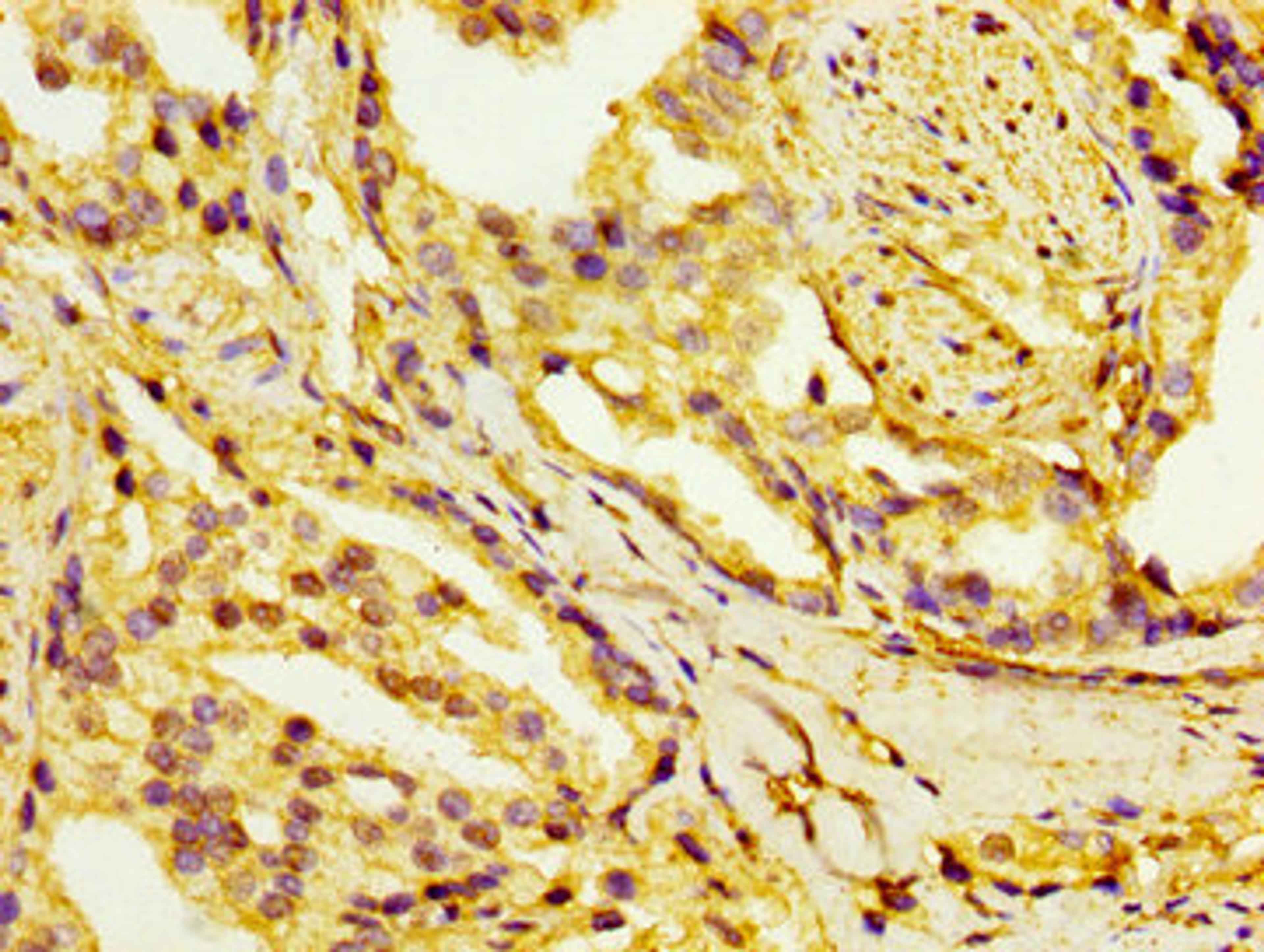IHC image of CSB-PA010766LA01HU diluted at 1:100 and staining in paraffin-embedded human prostate cancer performed on a Leica BondTM system. After dewaxing and hydration, antigen retrieval was mediated by high pressure in a citrate buffer (pH 6.0). Section was blocked with 10% normal goat serum 30min at RT. Then primary antibody (1% BSA) was incubated at 4&deg;C overnight. The primary is detected by a biotinylated secondary antibody and visualized using an HRP conjugated SP system.