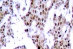 Immunohistochemistry: MEF2A [p Thr312] Antibody [NB100-92578] - MEF2A Phosphospecific Antibody [NB100-92578] - Immunohistochemistry (IHC) analyzes of p-MEF2A  (T312) antibody in paraffin-embedded human breast  carcinoma tissue.