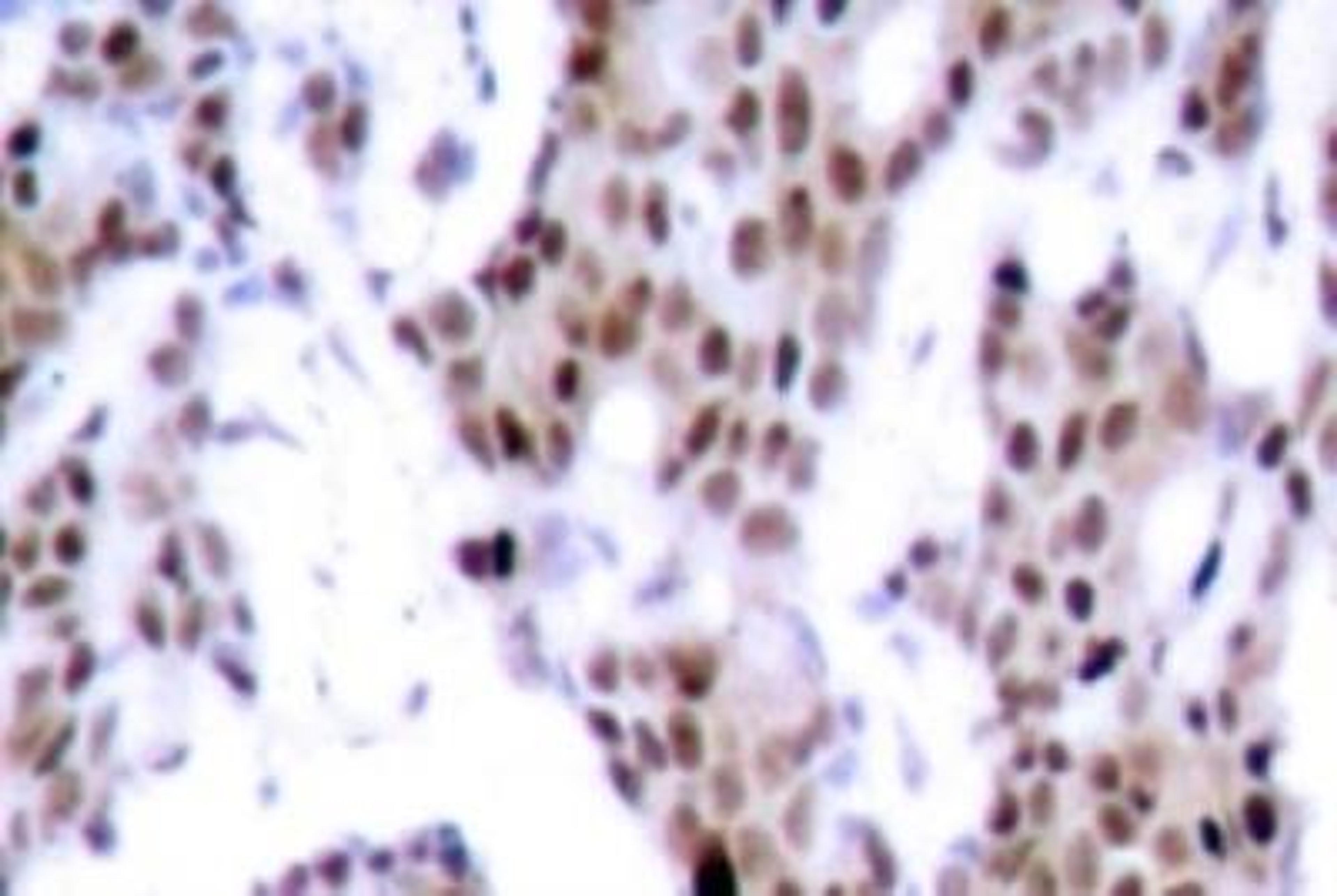 Immunohistochemistry: MEF2A [p Thr312] Antibody [NB100-92578] - MEF2A Phosphospecific Antibody [NB100-92578] - Immunohistochemistry (IHC) analyzes of p-MEF2A  (T312) antibody in paraffin-embedded human breast  carcinoma tissue.