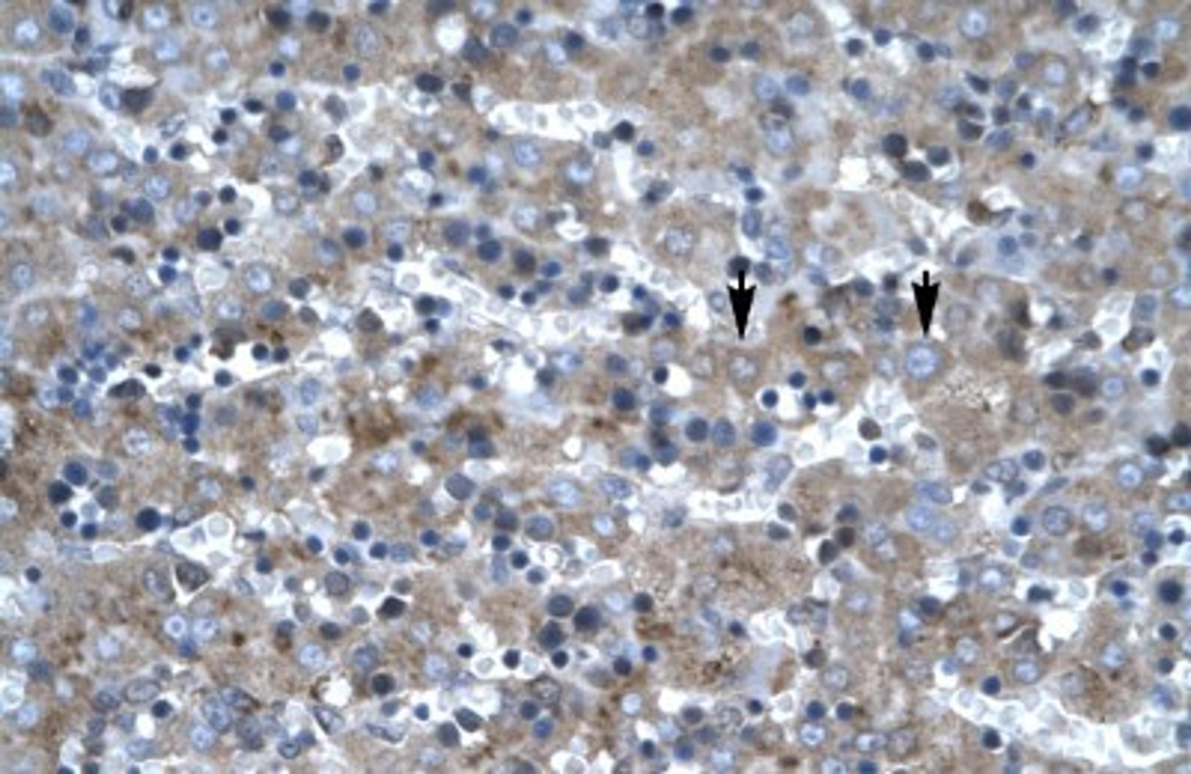 Immunohistochemistry-Paraffin: LHX6 Antibody [NB200-526] - Human Liver Tissue, antibody concentration 4-8ug/ml. Cells with positive label: Hepatocytes (indicated with arrows) 400X magnification.