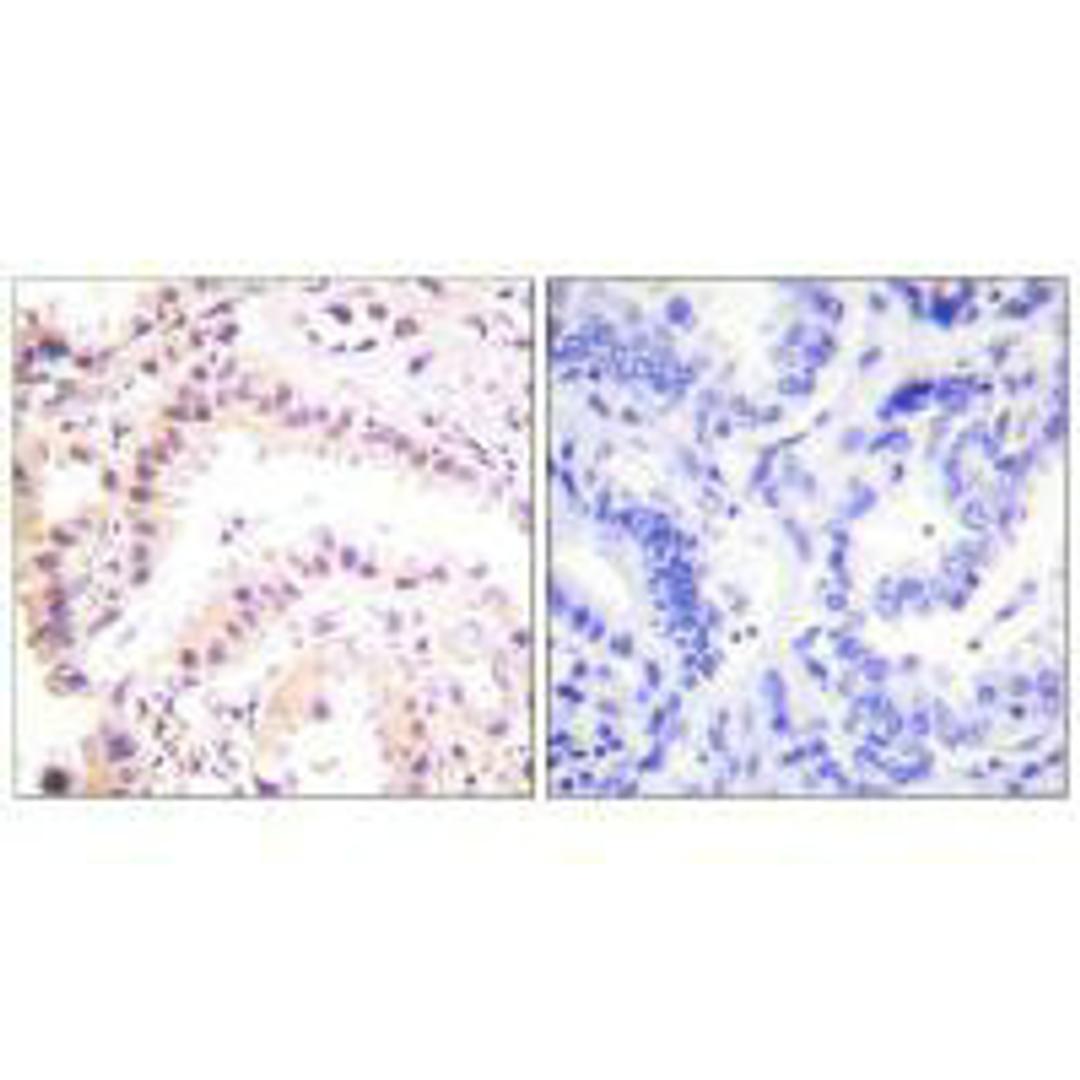 Immunohistochemical analysis of paraffin-embedded human lung carcinoma tissue using Cullin 2 antibody.