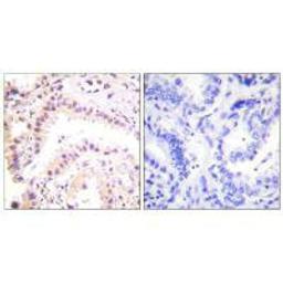 Immunohistochemical analysis of paraffin-embedded human lung carcinoma tissue using Cullin 2 antibody.