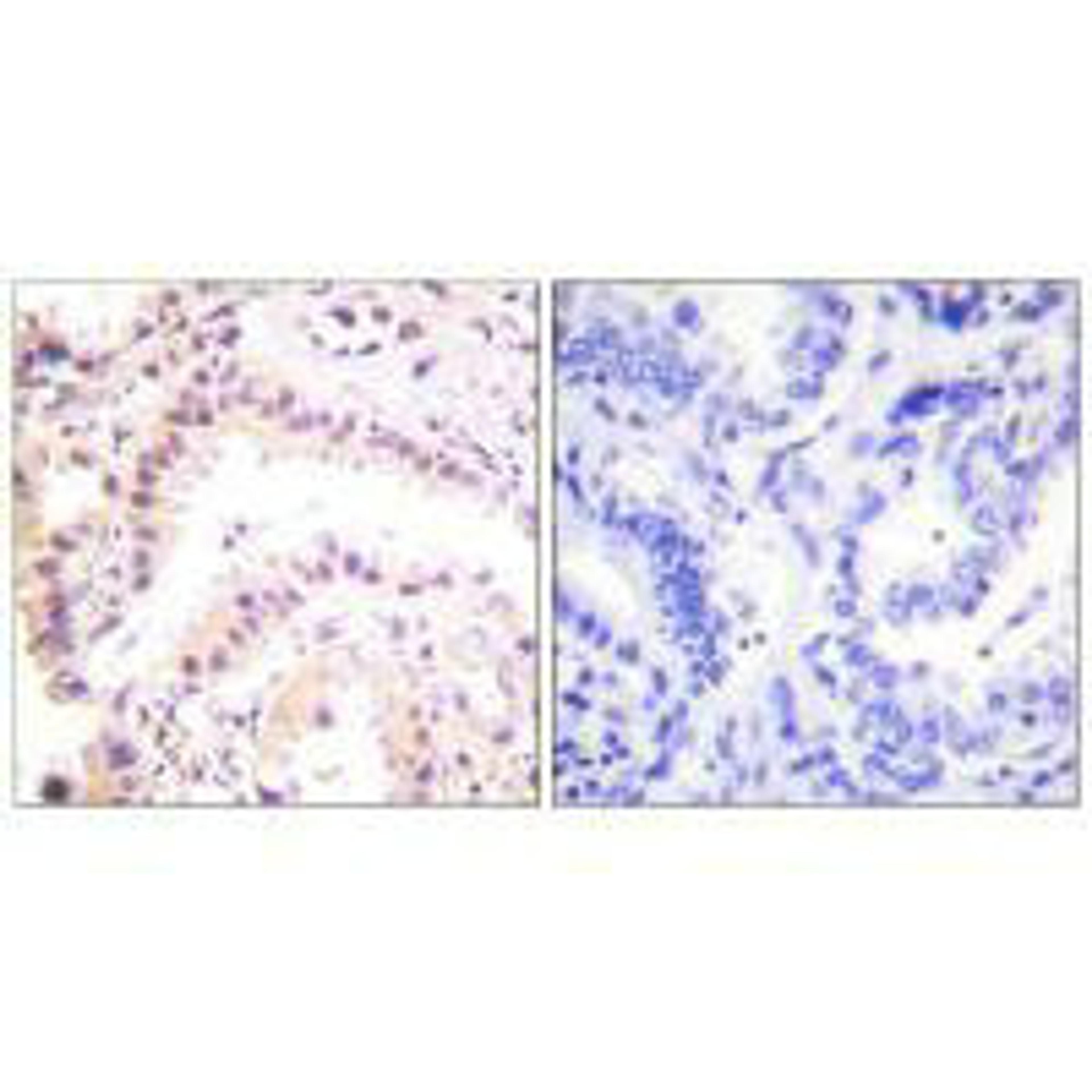 Immunohistochemical analysis of paraffin-embedded human lung carcinoma tissue using Cullin 2 antibody.