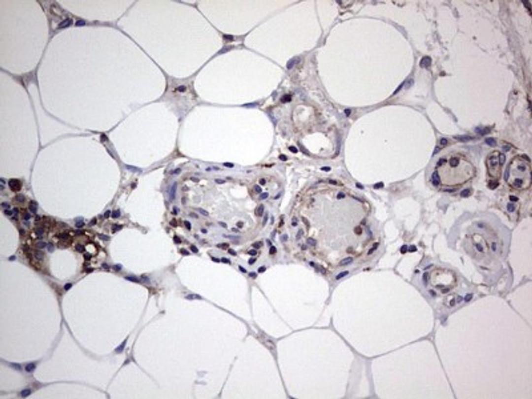 Immunohistochemistry: GARS Antibody (4G4) [NBP2-45808] - Analysis of Carcinoma of Human bladder tissue. (Heat-induced epitope retrieval by 1 mM EDTA in 10mM Tris, pH8.5, 120C for 3min)