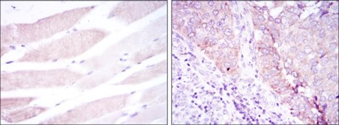 Immunohistochemistry: BMPR-II Antibody (3F6) [NBP2-37624] - Immunohistochemical analysis of paraffin-embedded muscle tissues (left) and kidney cancer tissues (right) using BMPR2 mouse mAb with DAB staining.