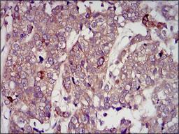 Immunohistochemistry: IGF-II Antibody (8H1) [NBP2-37462] - Immunohistochemical analysis of paraffin-embedded bladder cancer tissues using IGF2 mouse mAb with DAB staining.