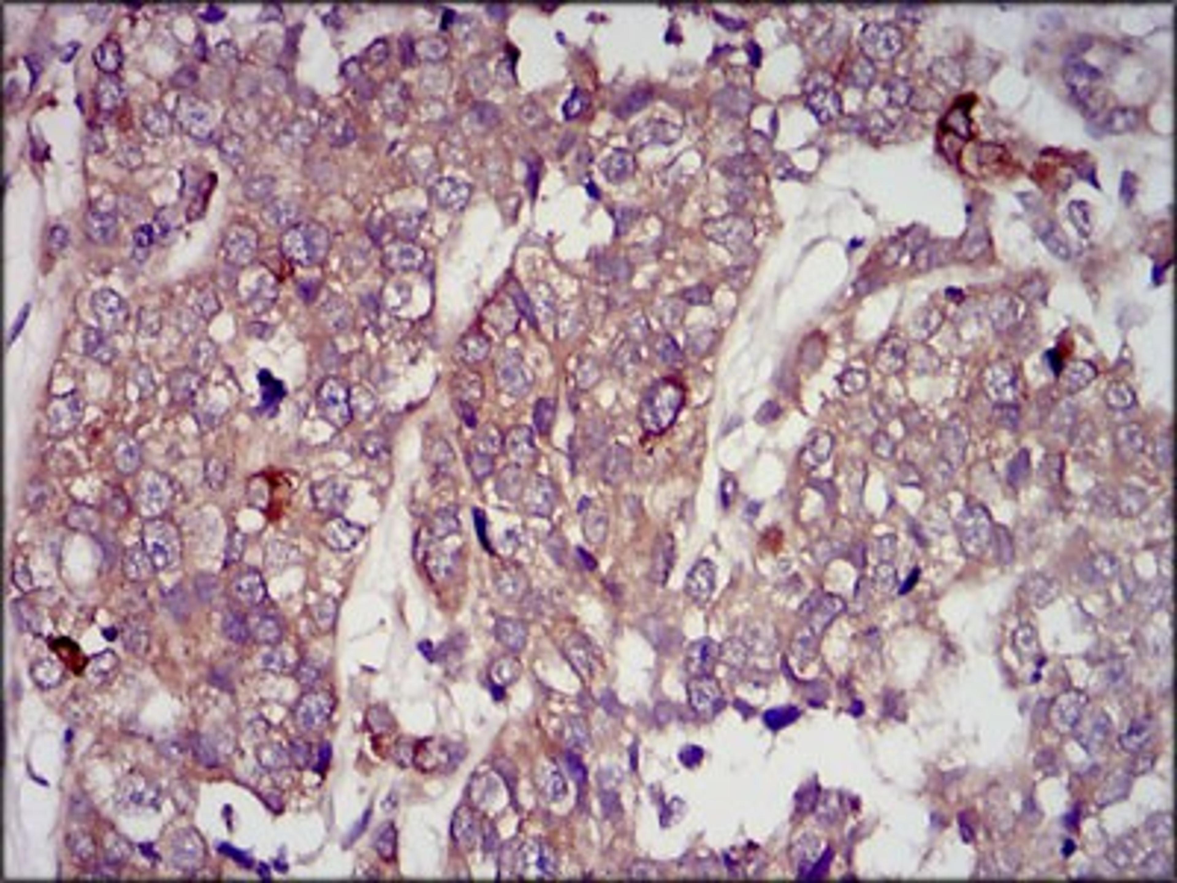 Immunohistochemistry: IGF-II Antibody (8H1) [NBP2-37462] - Immunohistochemical analysis of paraffin-embedded bladder cancer tissues using IGF2 mouse mAb with DAB staining.