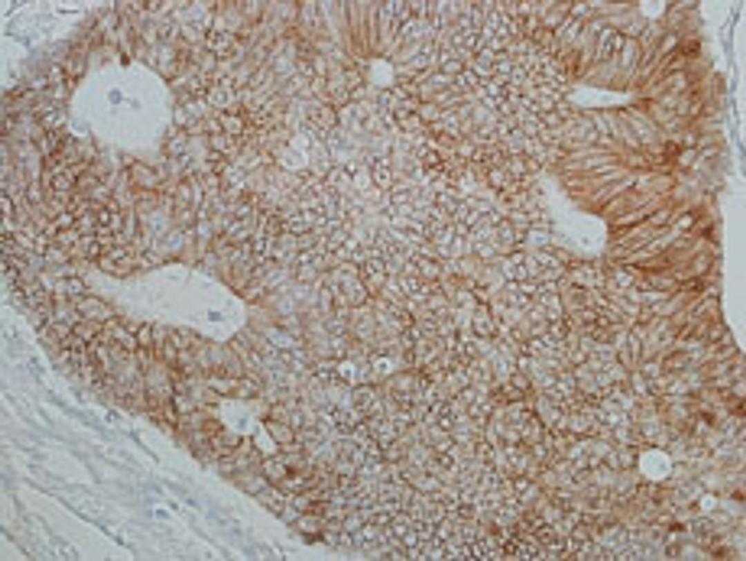 Detection of human beta Catenin in FFPE colon carcinoma by IHC.