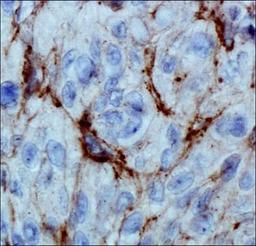 Immunohistochemistry: EGLN3/PHD3 Antibody (EG188e/d5) [NBP1-30440] - Analysis of HIF Prolyl Hydroxylase 3 in human renal cancer using DAB with hematoxylin counterstain.