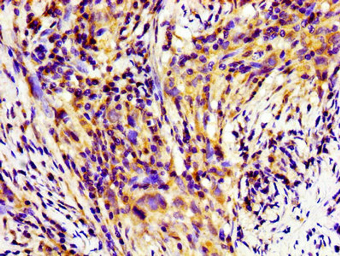 Immunohistochemistry of paraffin-embedded human pancreatic cancer using CSB-PA05639A0Rb at dilution of 1:100
