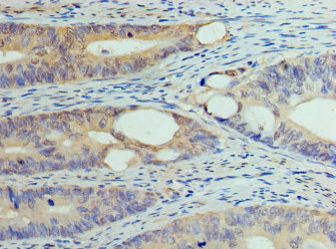 Immunohistochemistry of paraffin-embedded human colon cancer using CSB-PA007082HA01HU at dilution of 1:100