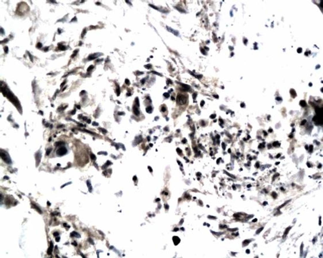 Immunohistochemical analysis of paraffin-embedded human colonic carcinoma tissue using TIMP4 antibody 