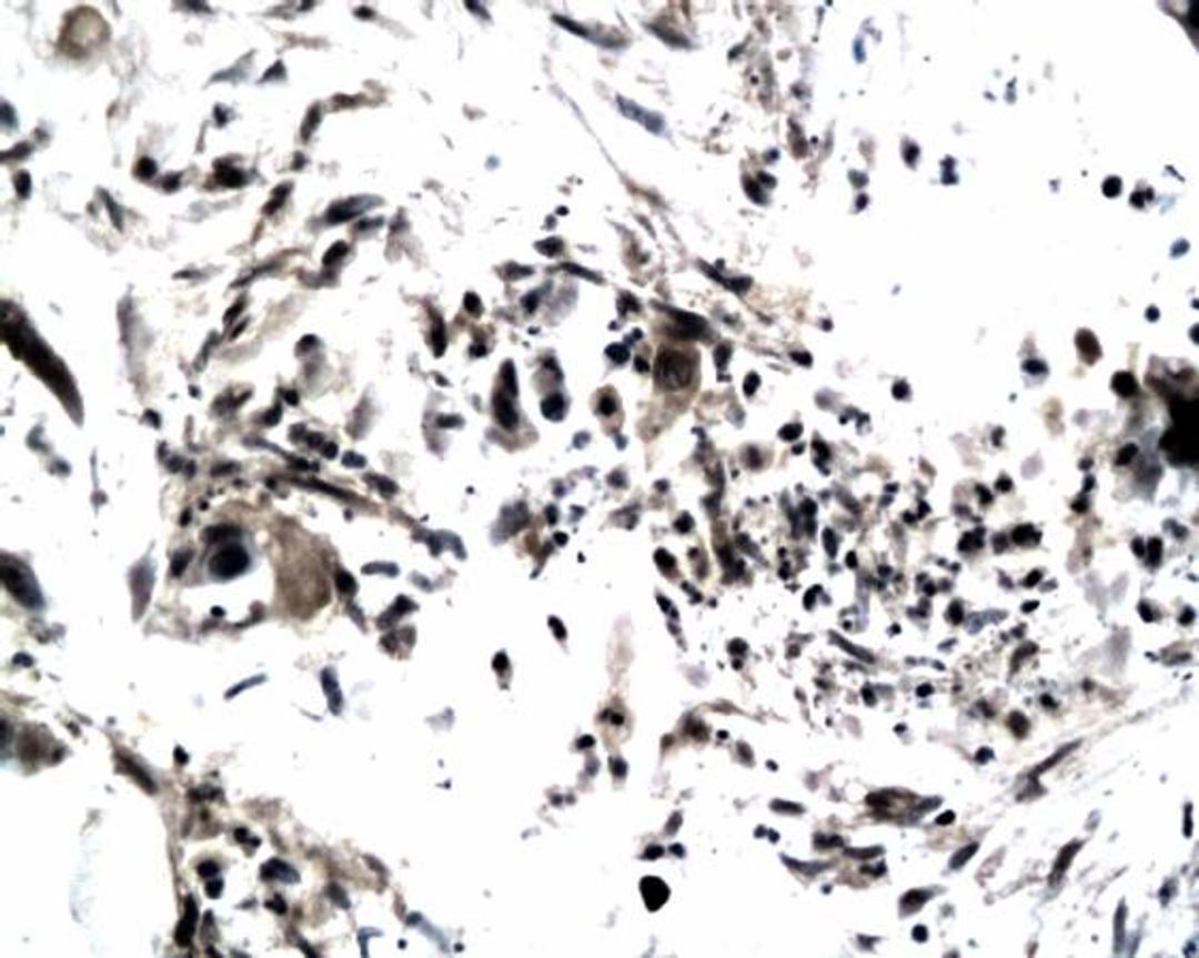 Immunohistochemical analysis of paraffin-embedded human colonic carcinoma tissue using TIMP4 antibody