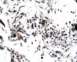 Immunohistochemical analysis of paraffin-embedded human colonic carcinoma tissue using TIMP4 antibody