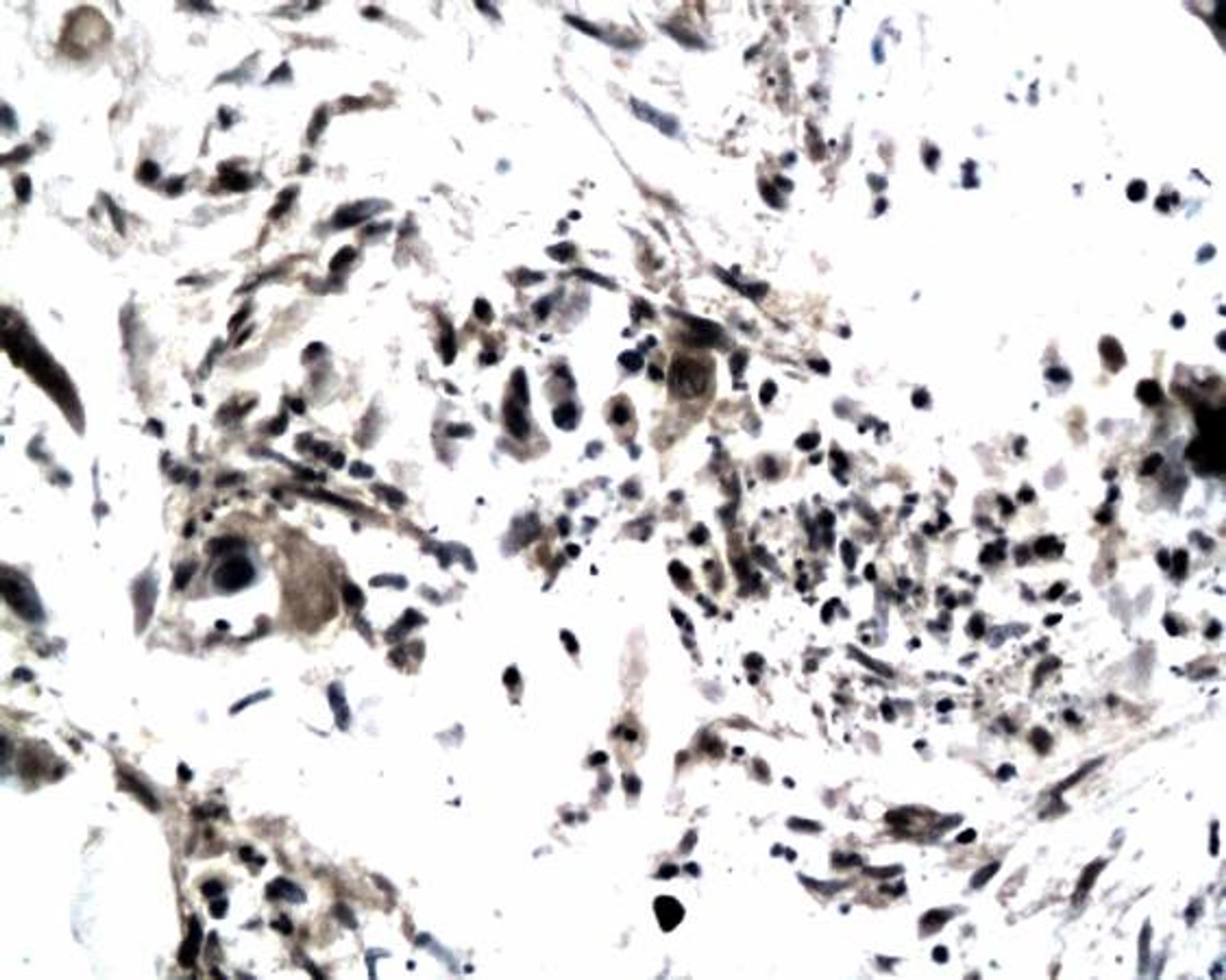 Immunohistochemical analysis of paraffin-embedded human colonic carcinoma tissue using TIMP4 antibody