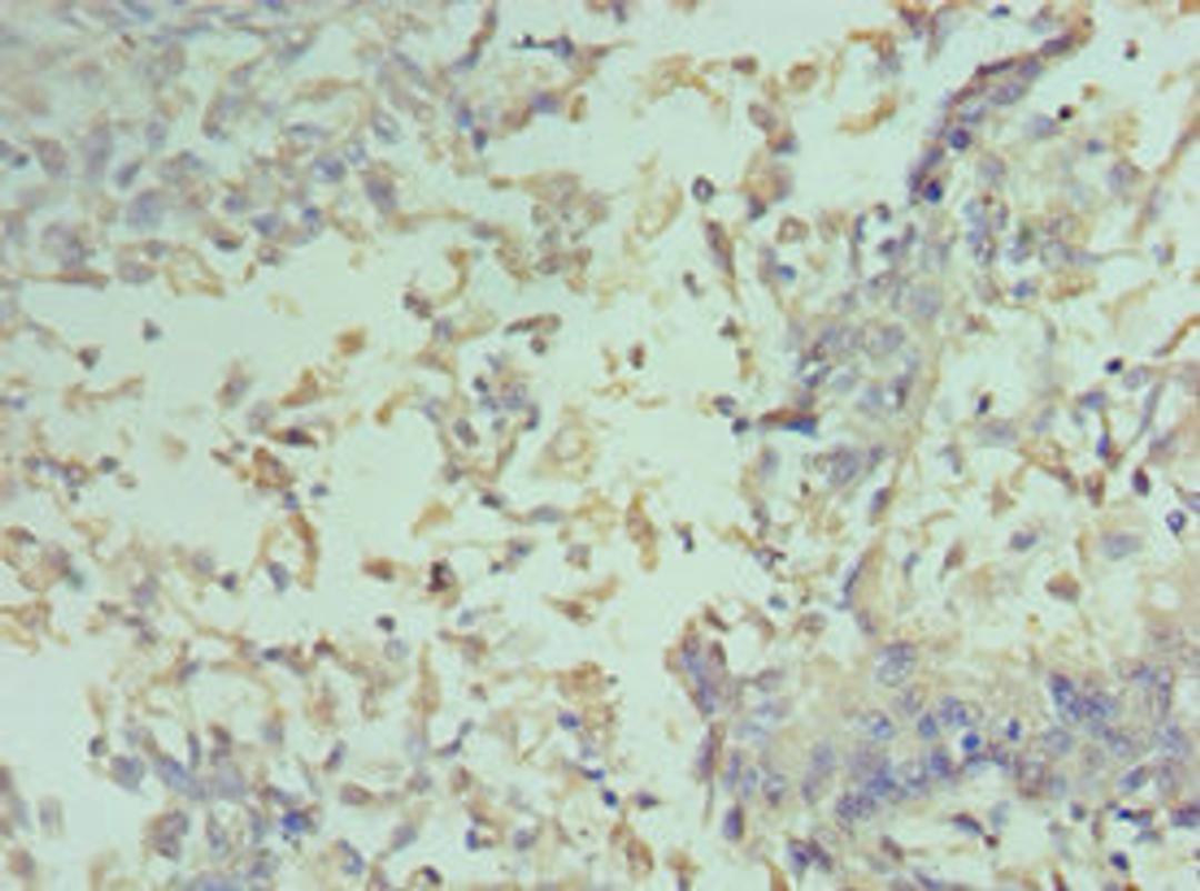 Immunohistochemistry of paraffin-embedded human cervical cancer using CSB-PA004812ESR2HU at dilution of 1:100