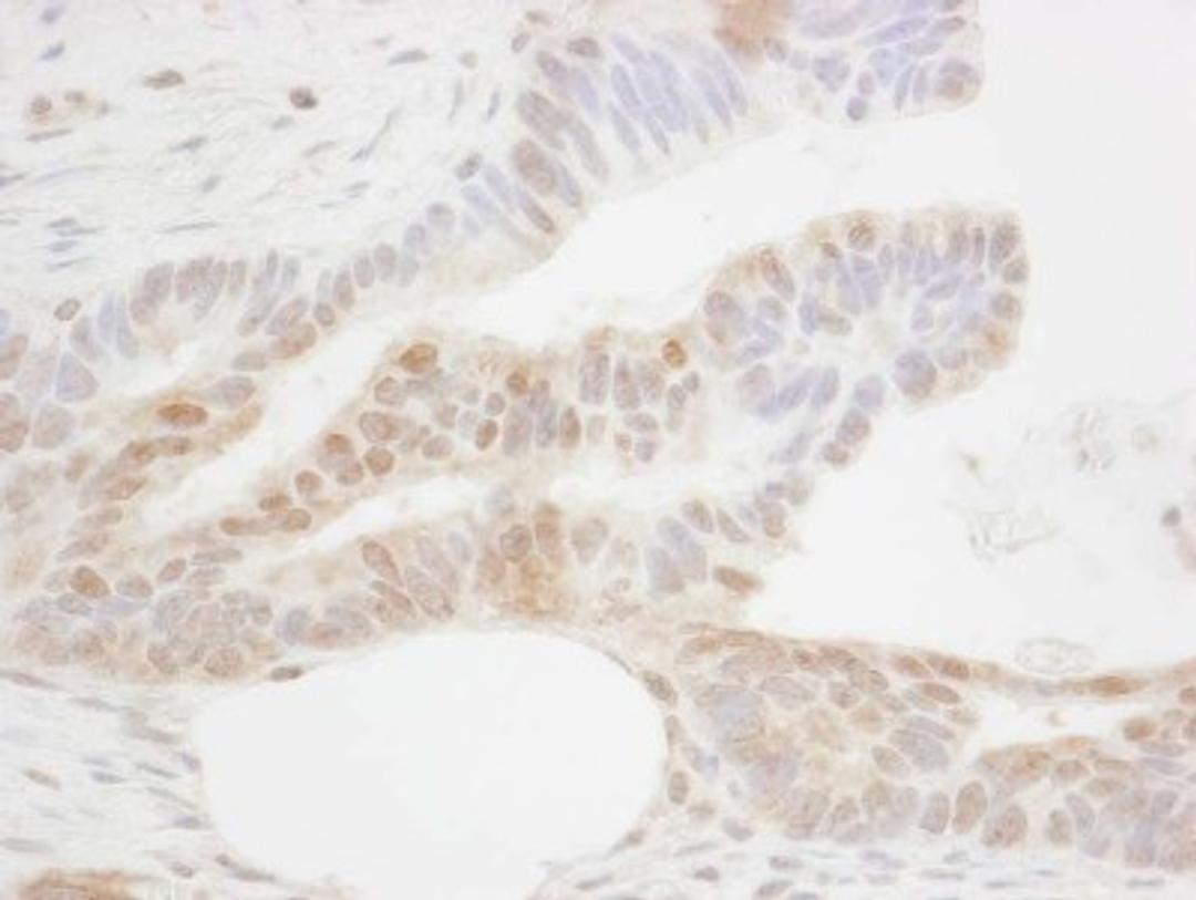 Immunohistochemistry-Paraffin: CDX2 Antibody [NB100-2136] - Human ovarian carcinoma. Antibody used at a dilution of 1:1000 (1ug/ml).