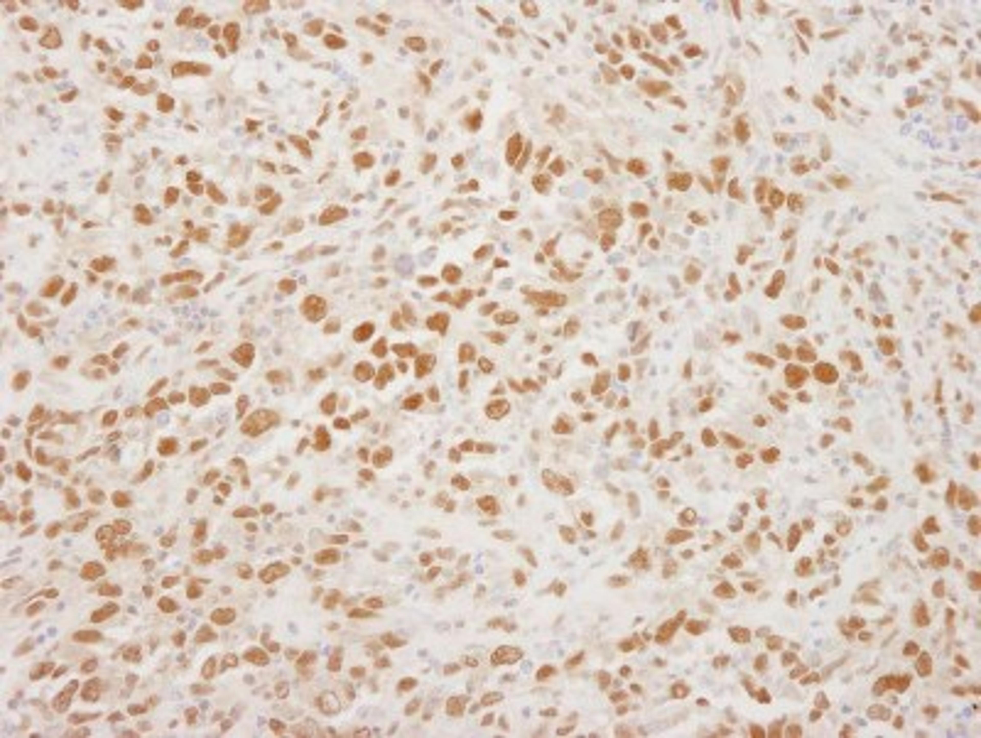 Immunohistochemistry-Paraffin: CRM1 Antibody [NB100-79802] - Human metastatic lymph node.  Antibody used at a dilution of 1:5,000 (0.2ug/ml).