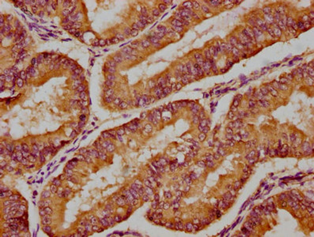 IHC image of CSB-PA622675HA01HU diluted at 1:300 and staining in paraffin-embedded human endometrial cancer performed on a Leica BondTM system. After dewaxing and hydration, antigen retrieval was mediated by high pressure in a citrate buffer (pH 6.0). Section was blocked with 10% normal goat serum 30min at RT. Then primary antibody (1% BSA) was incubated at 4°C overnight. The primary is detected by a biotinylated secondary antibody and visualized using an HRP conjugated SP system.