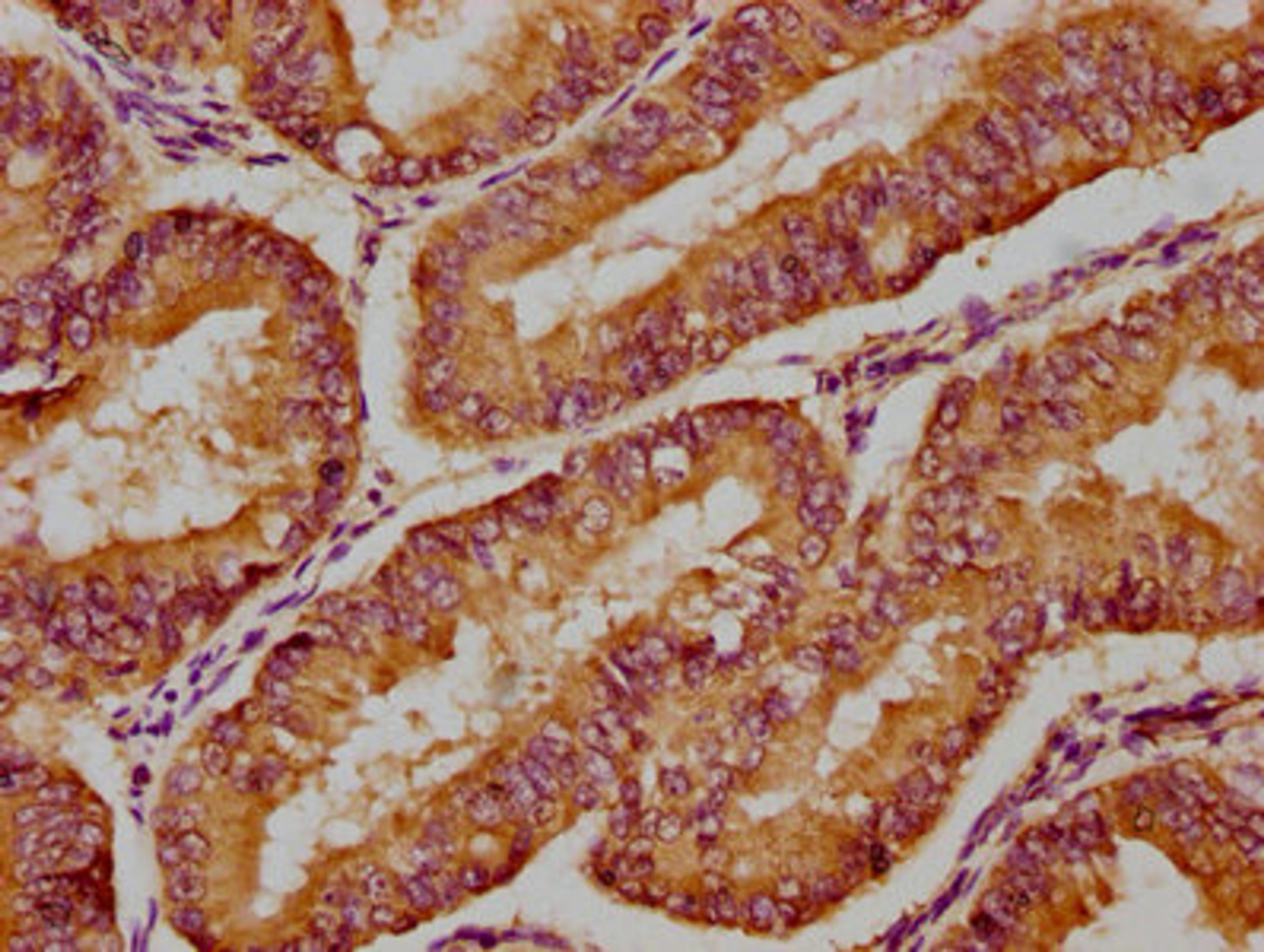 IHC image of CSB-PA622675HA01HU diluted at 1:300 and staining in paraffin-embedded human endometrial cancer performed on a Leica BondTM system. After dewaxing and hydration, antigen retrieval was mediated by high pressure in a citrate buffer (pH 6.0). Section was blocked with 10% normal goat serum 30min at RT. Then primary antibody (1% BSA) was incubated at 4°C overnight. The primary is detected by a biotinylated secondary antibody and visualized using an HRP conjugated SP system.