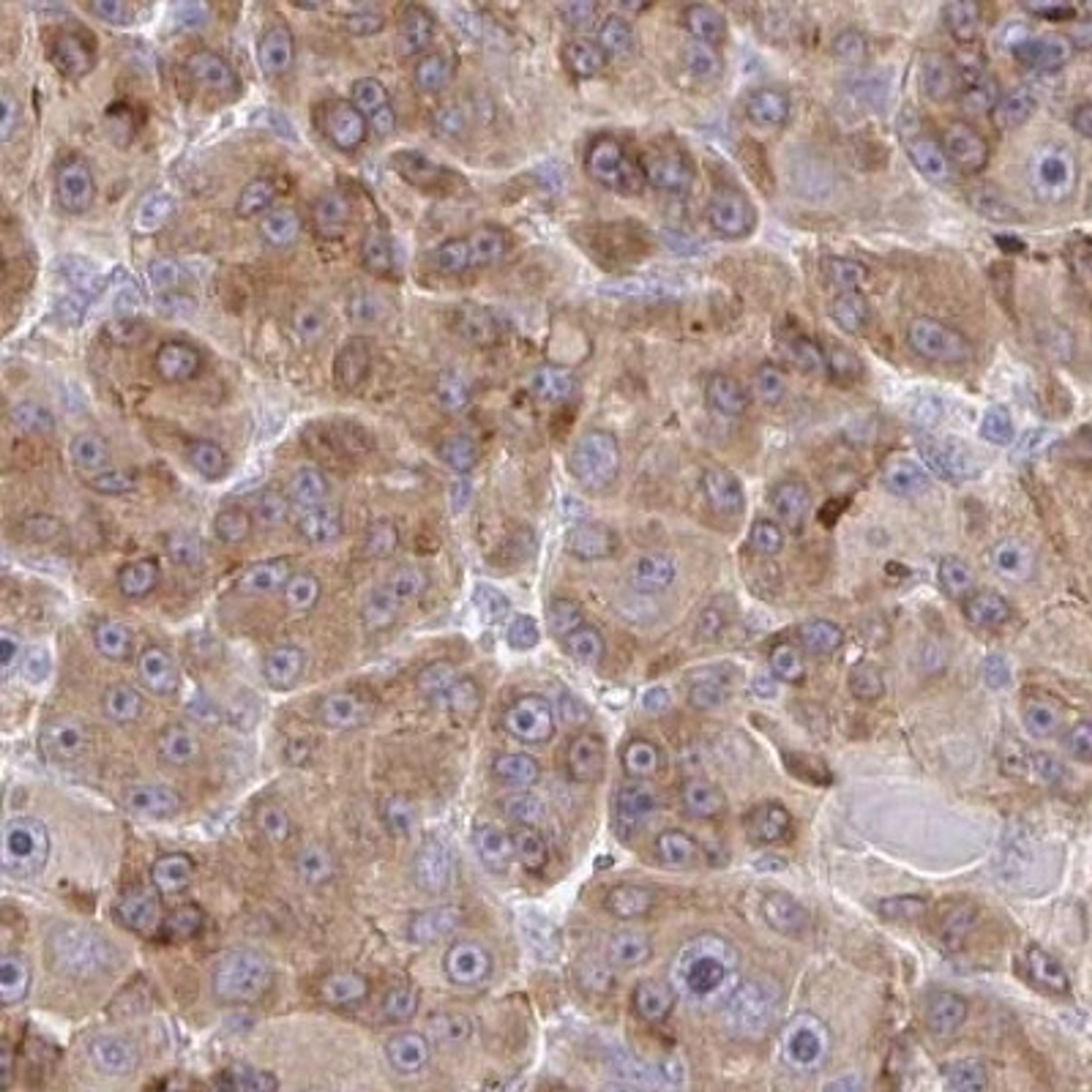 Immunohistochemistry: HCFC1R1 Antibody [NBP2-31788] - liver cancer