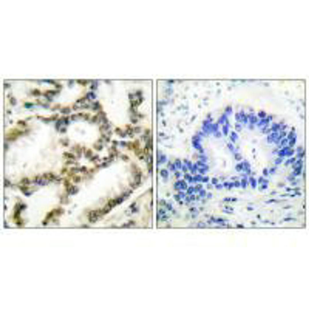 Immunohistochemical analysis of paraffin-embedded human lung carcinoma tissue using DJ-1 antibody.